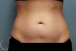 Coolsculpting Case 6 Before